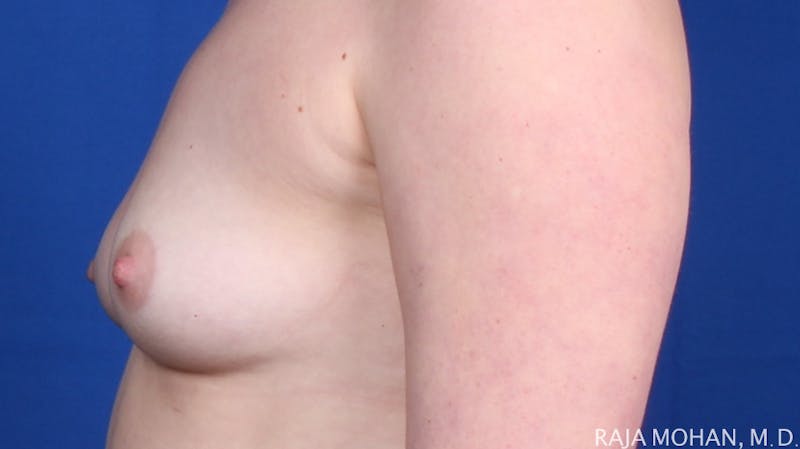 Breast Augmentation Before & After Gallery - Patient 385027 - Image 3