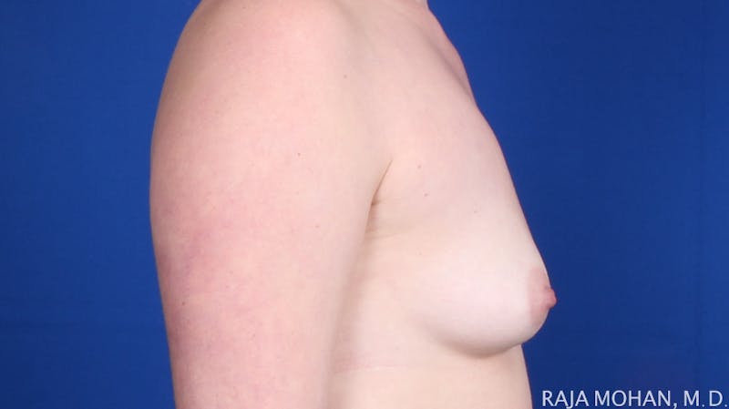 Breast Augmentation Before & After Gallery - Patient 385027 - Image 7