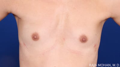 Breast Augmentation Before & After Gallery - Patient 298875 - Image 1