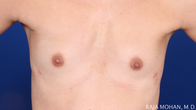 Breast Augmentation Before & After Gallery - Patient 298875 - Image 1