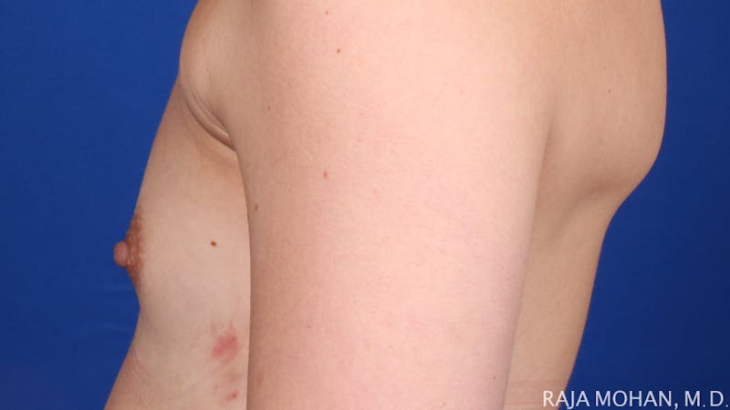 Breast Augmentation Before & After Gallery - Patient 298875 - Image 3