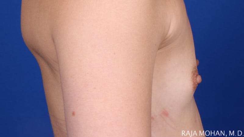 Breast Augmentation Before & After Gallery - Patient 298875 - Image 7