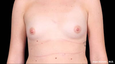 Breast Augmentation Before & After Gallery - Patient 231631 - Image 1