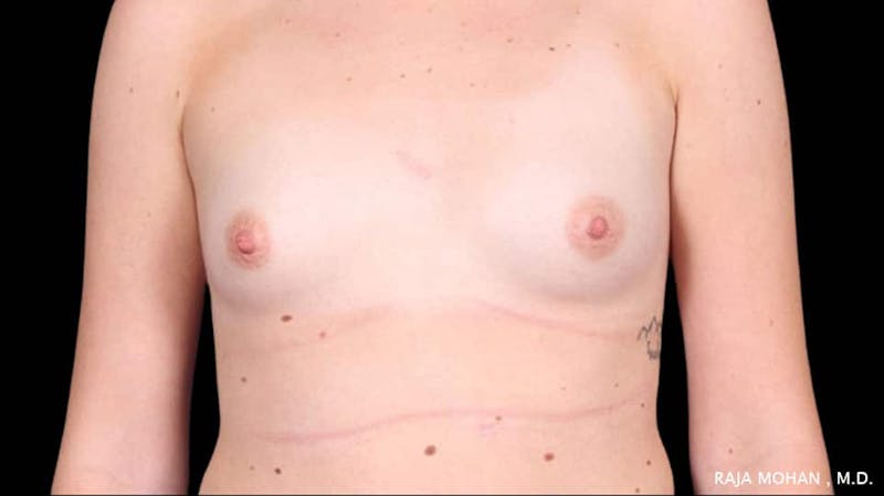 Breast Augmentation Before & After Gallery - Patient 231631 - Image 1
