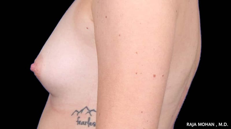 Breast Augmentation Before & After Gallery - Patient 231631 - Image 3