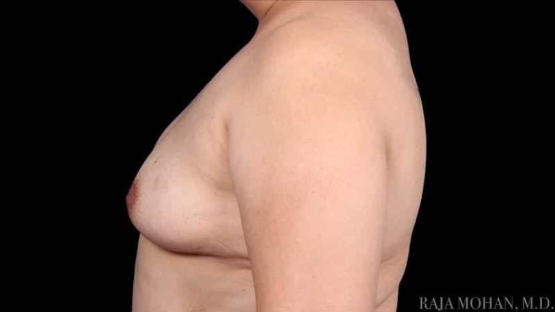 Breast Augmentation Before & After Gallery - Patient 120507 - Image 3