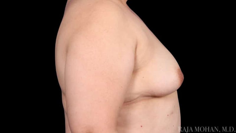 Breast Augmentation Before & After Gallery - Patient 120507 - Image 7