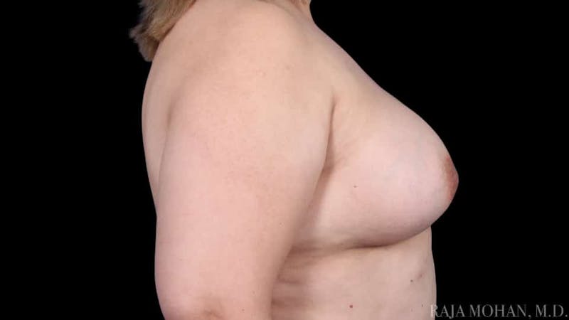 Breast Augmentation Before & After Gallery - Patient 120507 - Image 8