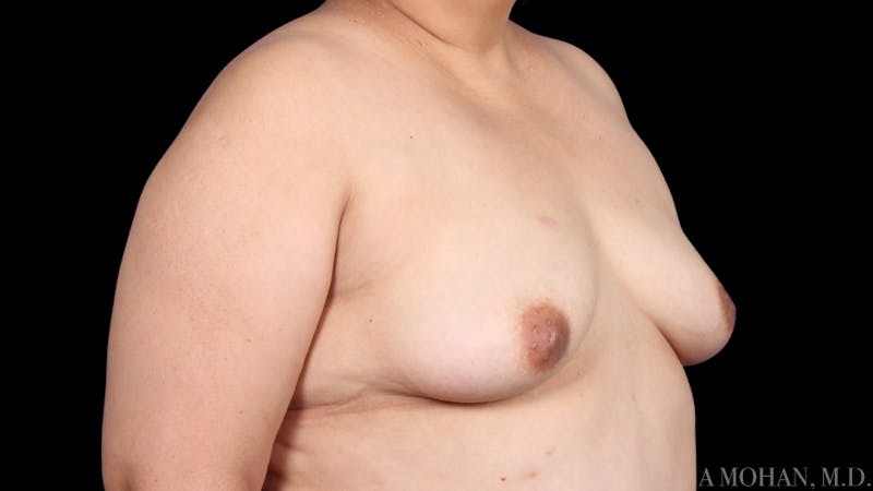Breast Augmentation Before & After Gallery - Patient 120507 - Image 9