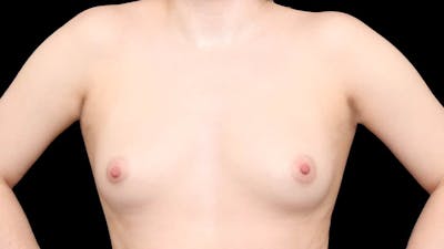 Breast Augmentation Before & After Gallery - Patient 109840 - Image 1