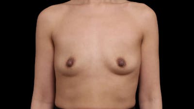 Breast Augmentation Before & After Gallery - Patient 150178 - Image 1