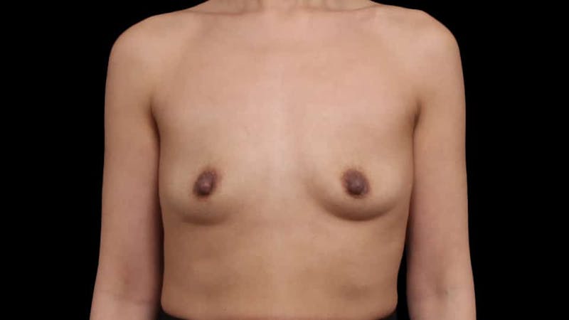 Breast Augmentation Before & After Gallery - Patient 150178 - Image 1
