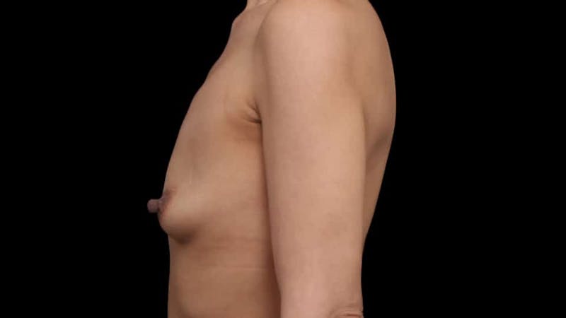 Breast Augmentation Before & After Gallery - Patient 150178 - Image 5