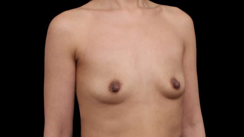 Breast Augmentation Before & After Gallery - Patient 150178 - Image 7