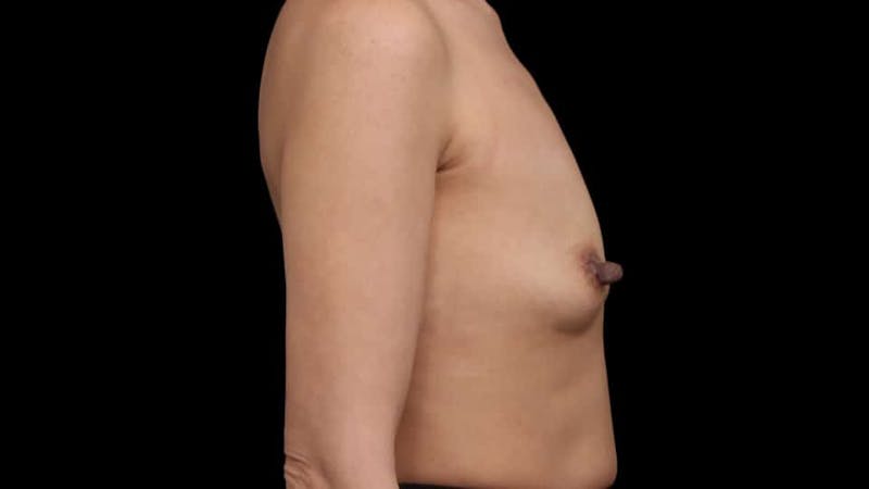 Breast Augmentation Before & After Gallery - Patient 150178 - Image 9
