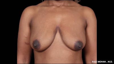 Breast Lift Before & After Gallery - Patient 118778 - Image 1