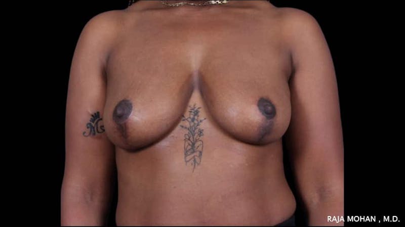 Breast Lift Before & After Gallery - Patient 118778 - Image 2
