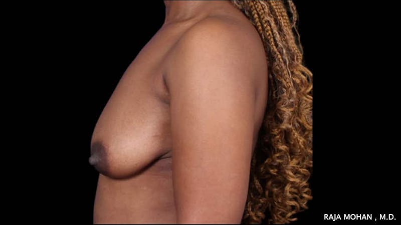 Breast Lift Before & After Gallery - Patient 118778 - Image 3
