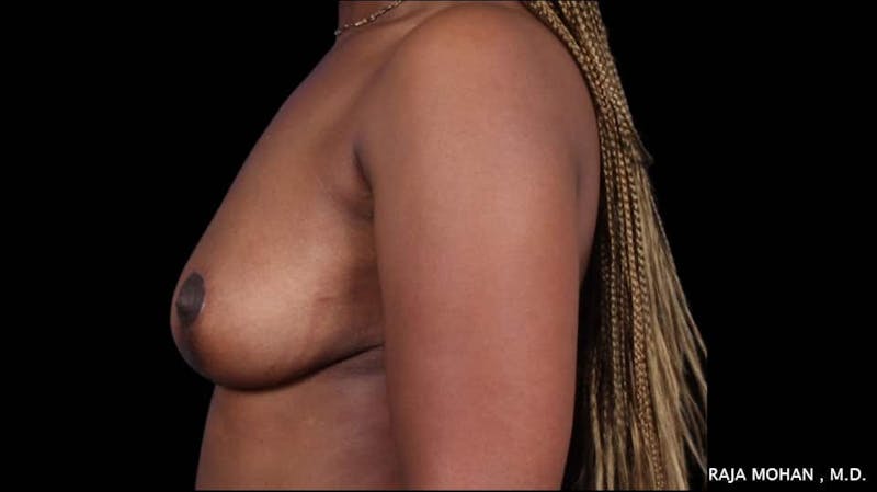 Breast Lift Before & After Gallery - Patient 118778 - Image 4