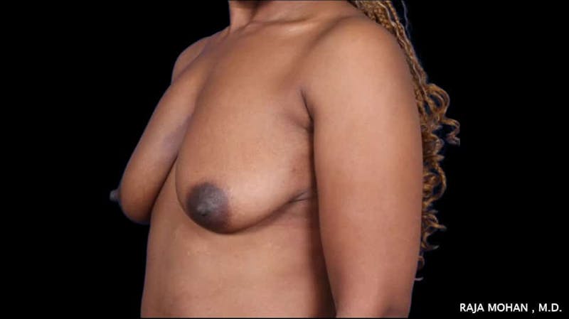 Breast Lift Before & After Gallery - Patient 118778 - Image 5