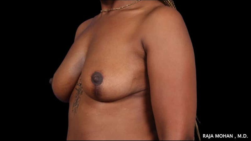 Breast Lift Before & After Gallery - Patient 118778 - Image 6