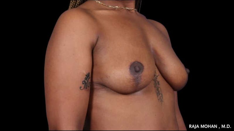Breast Lift Before & After Gallery - Patient 118778 - Image 8