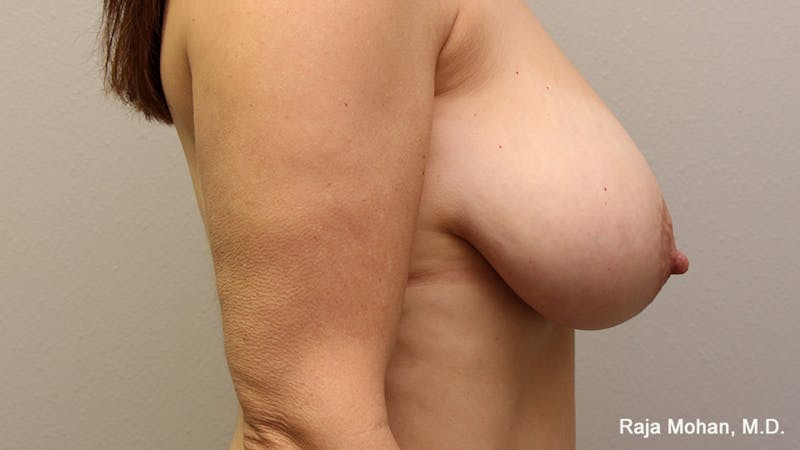 Breast Lift Before & After Gallery - Patient 370117 - Image 3
