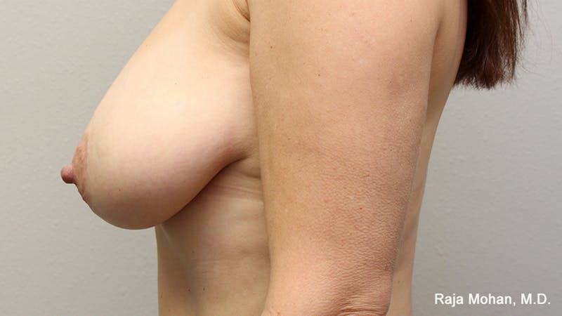 Breast Lift Before & After Gallery - Patient 370117 - Image 7