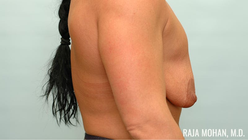 Breast Lift Before & After Gallery - Patient 188681 - Image 5