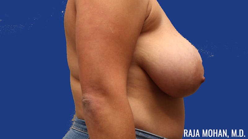 Breast Lift Before & After Gallery - Patient 414544 - Image 5