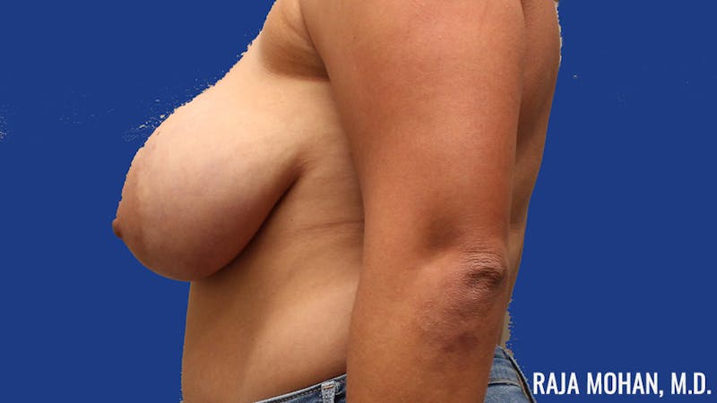 Breast Lift Before & After Gallery - Patient 414544 - Image 7