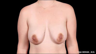 Breast Lift Before & After Gallery - Patient 225675 - Image 1