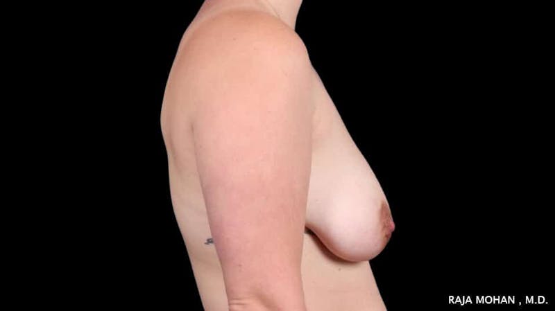 Breast Lift Before & After Gallery - Patient 225675 - Image 9