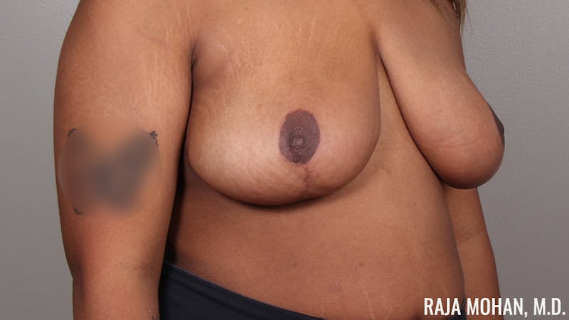 Breast Reduction Before & After Gallery - Patient 411043 - Image 4