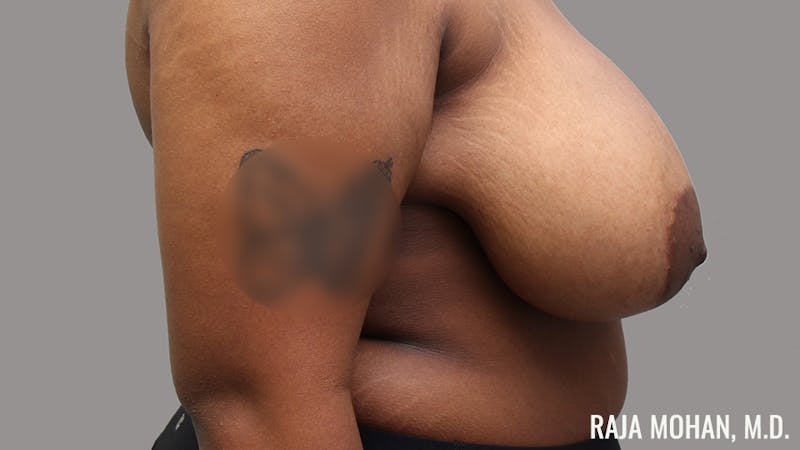 Breast Reduction Before & After Gallery - Patient 411043 - Image 5