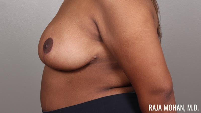 Breast Reduction Before & After Gallery - Patient 411043 - Image 8
