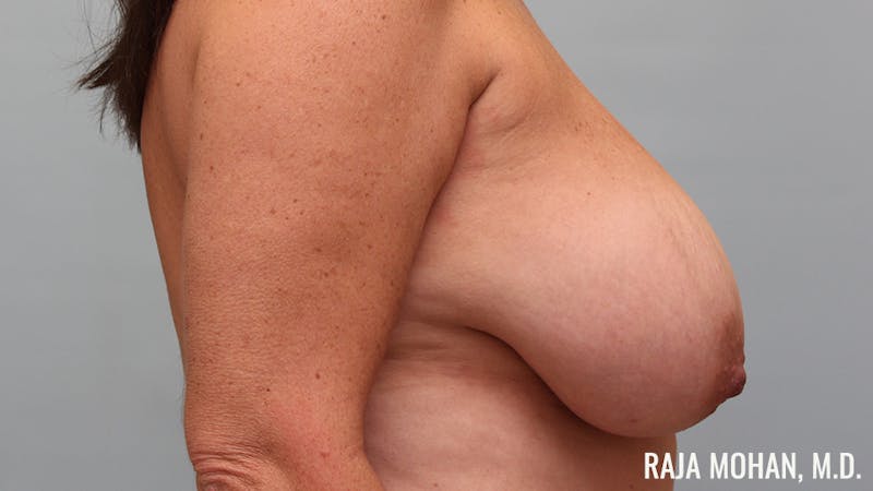 Breast Reduction Before & After Gallery - Patient 387538 - Image 5