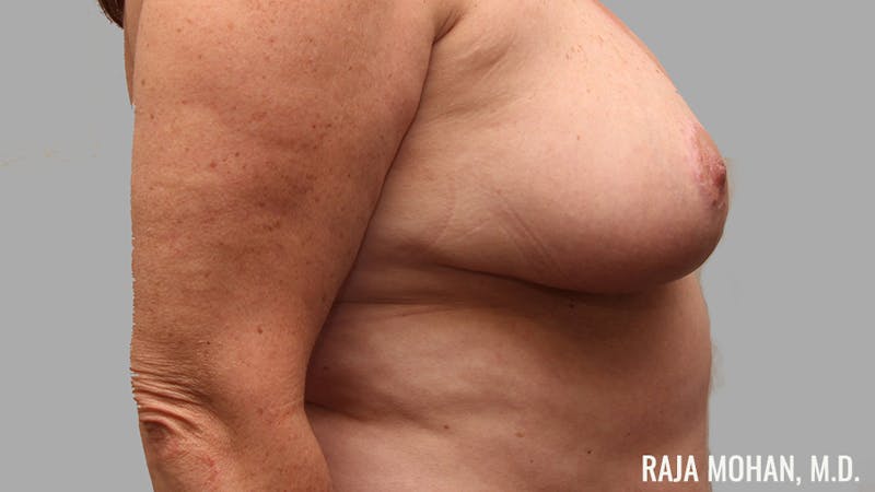 Breast Reduction Before & After Gallery - Patient 387538 - Image 6