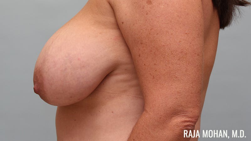 Breast Reduction Before & After Gallery - Patient 387538 - Image 7