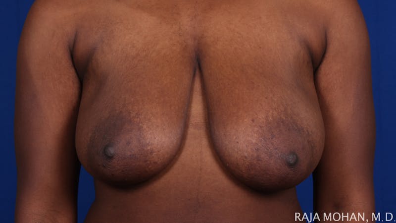 Breast Reduction Before & After Gallery - Patient 103891 - Image 1