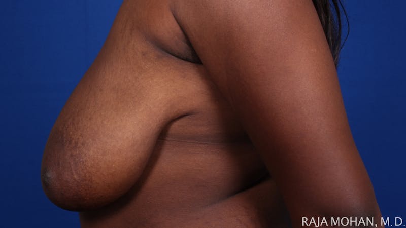 Breast Reduction Before & After Gallery - Patient 103891 - Image 3