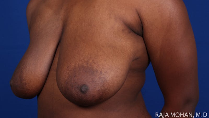 Breast Reduction Before & After Gallery - Patient 103891 - Image 5