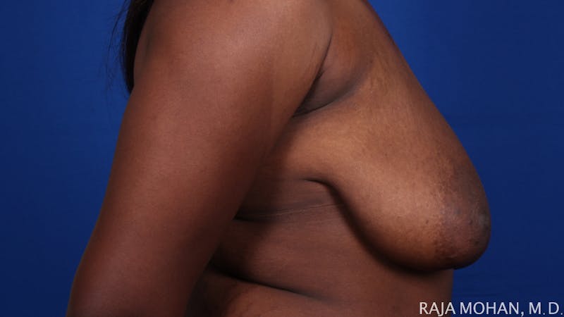 Breast Reduction Before & After Gallery - Patient 103891 - Image 7