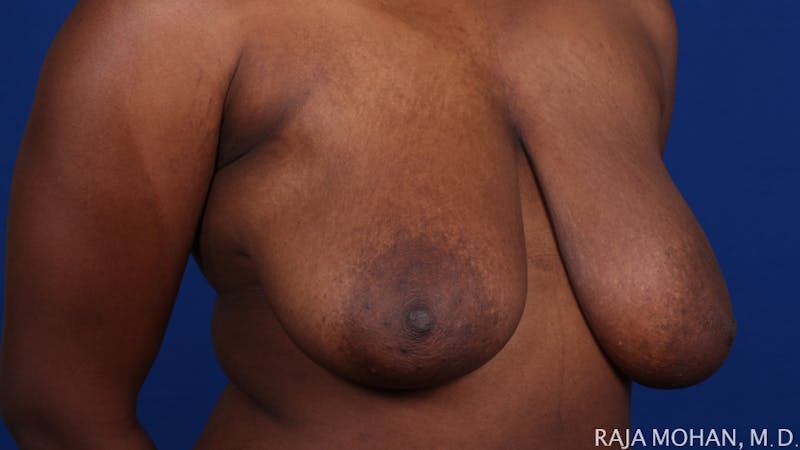 Breast Reduction Before & After Gallery - Patient 103891 - Image 9
