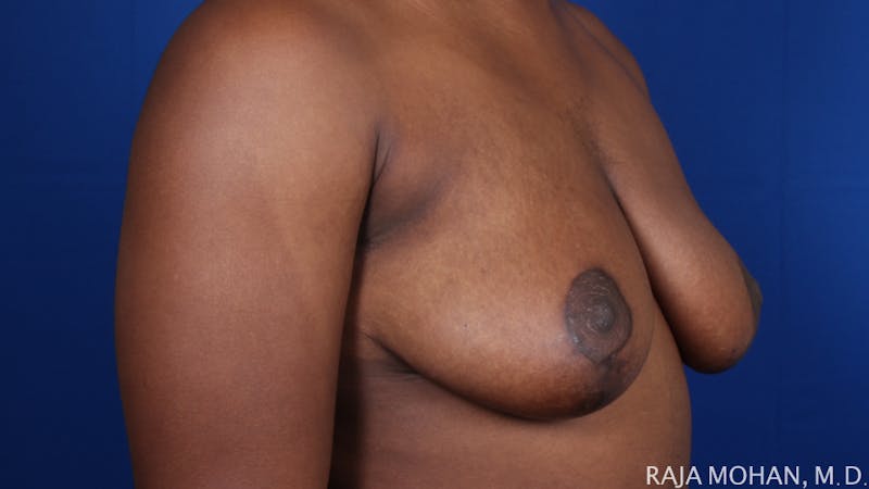 Breast Reduction Before & After Gallery - Patient 103891 - Image 10