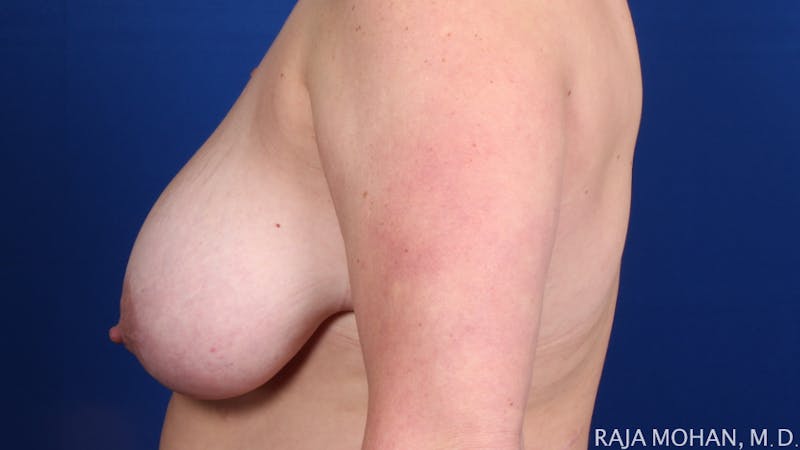 Breast Reduction Before & After Gallery - Patient 377623 - Image 3