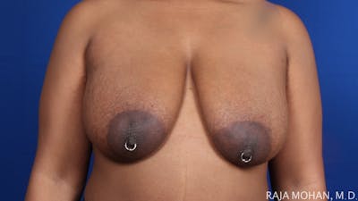 Breast Reduction Before & After Gallery - Patient 352397 - Image 1