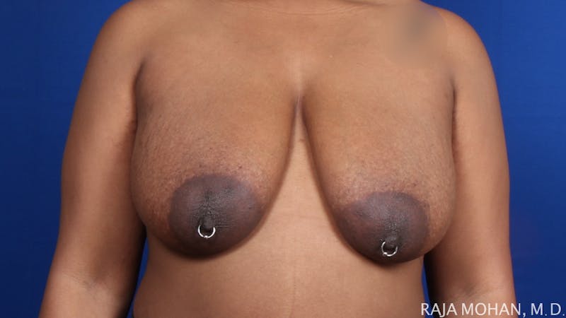 Breast Reduction Before & After Gallery - Patient 352397 - Image 1