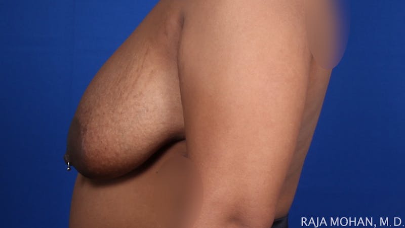 Breast Reduction Before & After Gallery - Patient 352397 - Image 3