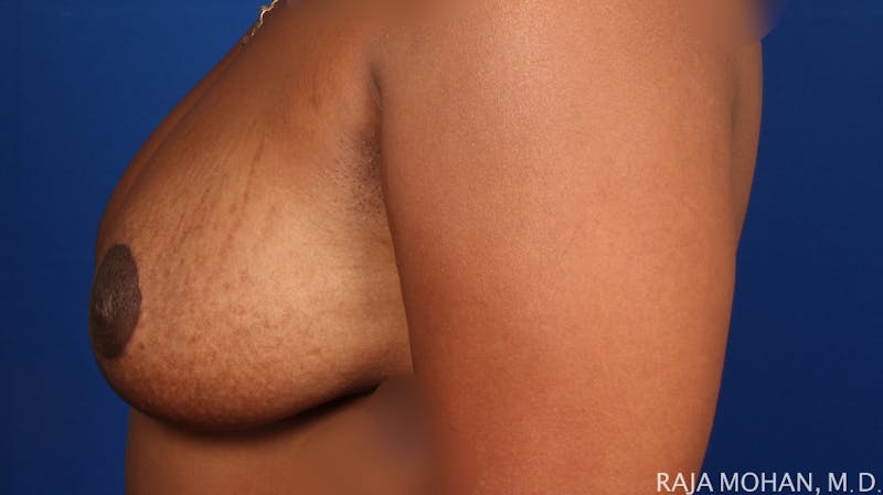 Breast Reduction Before & After Gallery - Patient 352397 - Image 4